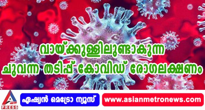 വായ്ക്കുള്ളിലുണ്ടാകുന്ന ചുവന്ന തടിപ്പ് കോവിഡ് രോഗലക്ഷണം